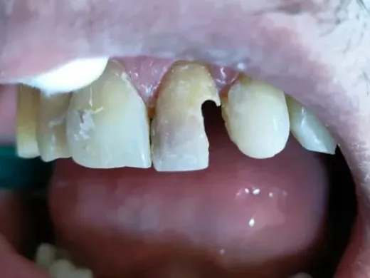 Resultado antes - Restauración dental