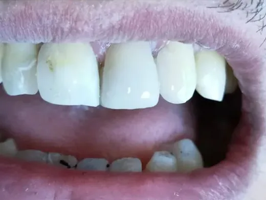 Resultado después - Restauración dental